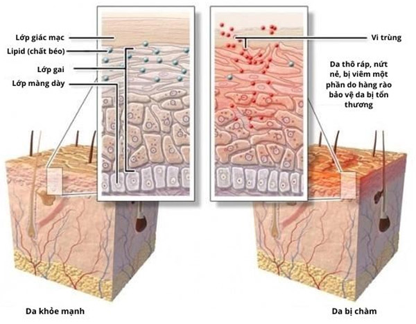 Sự khác biệt giữa da người bình thường và da người bị chàm